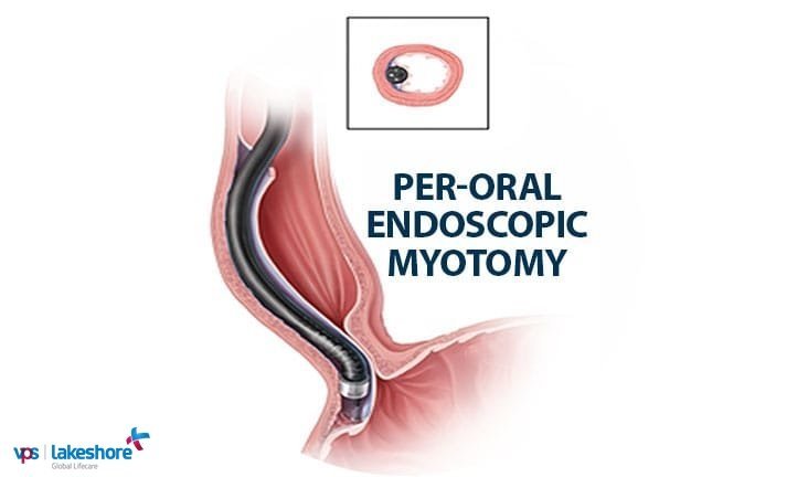 'Poem' to solve Esophageal Problems
