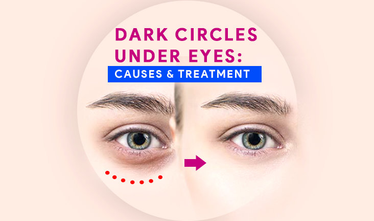 Dark Circles Under Eyes: Causes & Treatment