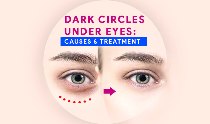 Dark Circles Under The Eyes: Causes & Treatments