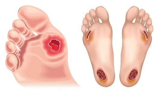 Diabetic Foot Infection - Causes and Treatment