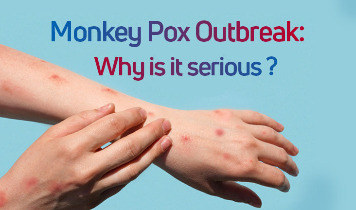 The new Monkey Pox outbreak raises numerous questions. Why is it serious?