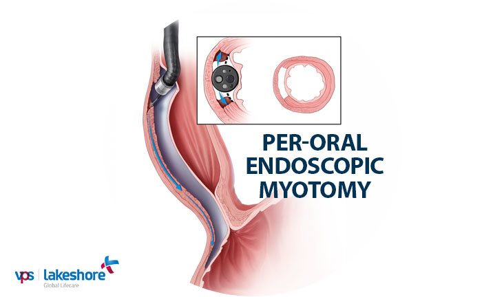 Per-oral Endoscopic Myotomy (POEM) for Achalasia