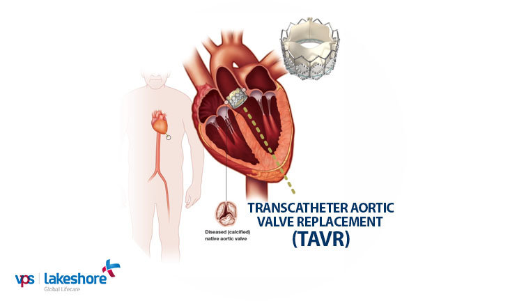 Aortic Stenosis resolved in 75 year old patient through TAVR