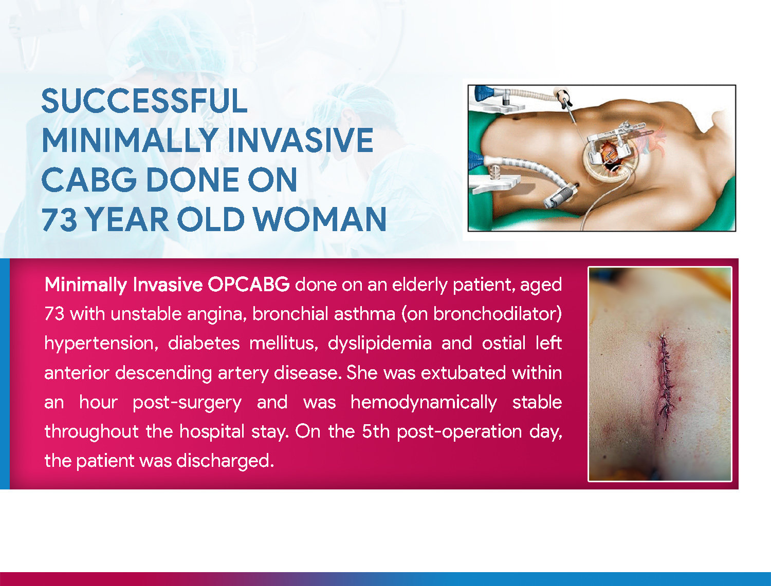 Successful Minimally Invasive CABG done on an elderly woman