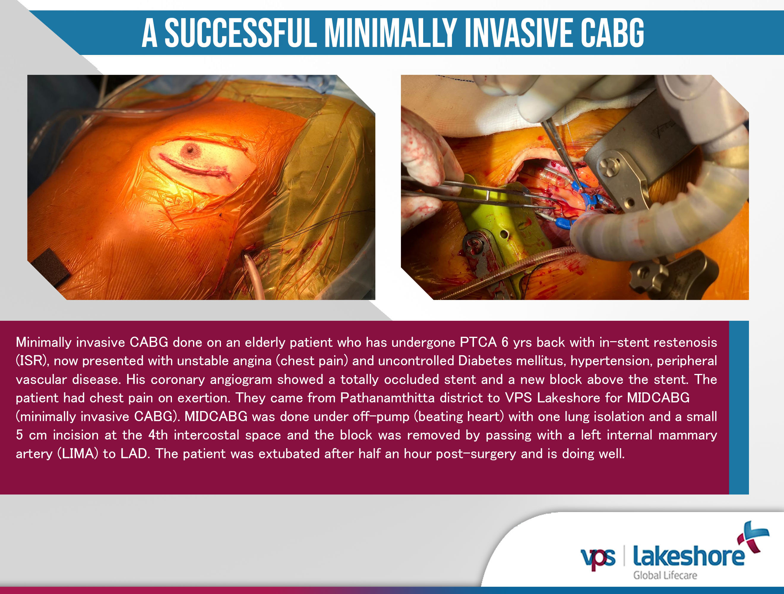 A successful Minimally Invasive CABG