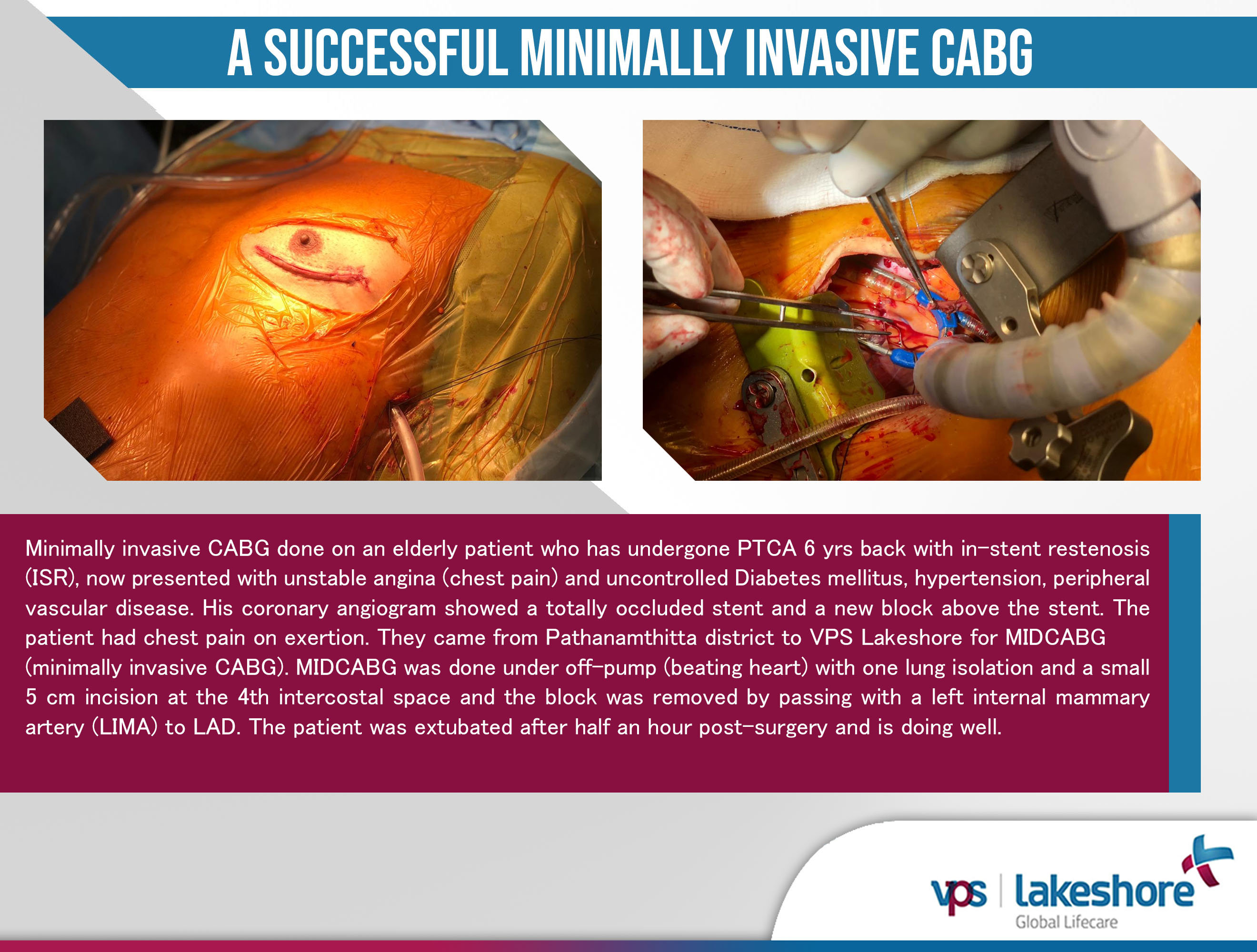 uploads/news/minimallyinvasivecabgsurgery-tnVjMJBCwHPm0hE.jpg