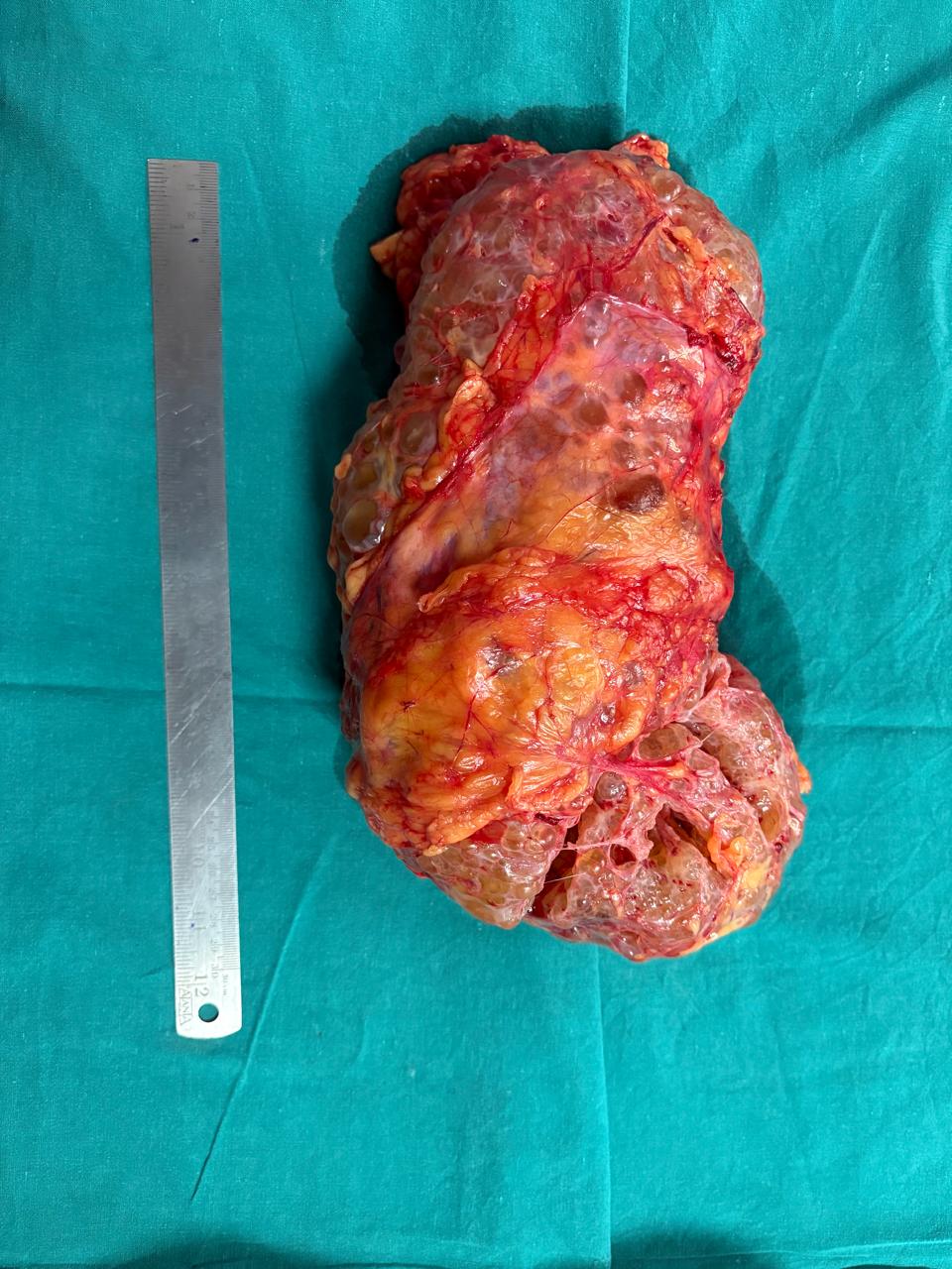 Giant Polycystic Kidney
